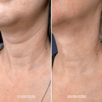 Crema para el cuello Reafirma & Alisa Nuvessia®
