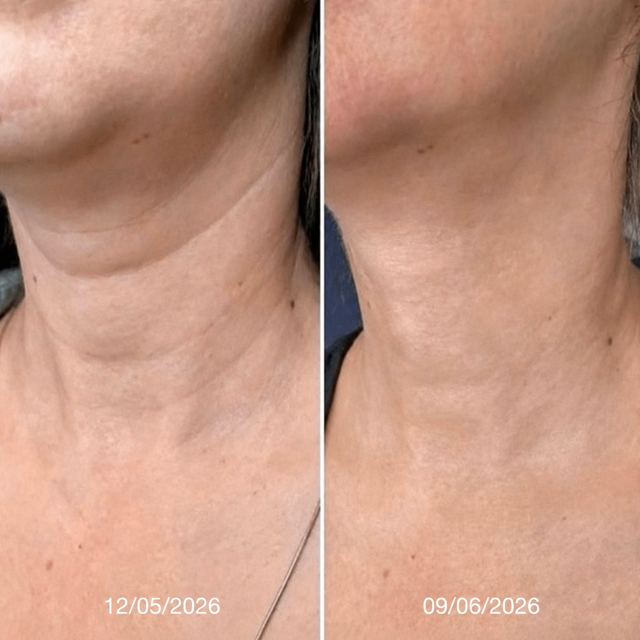 Crema para el cuello Reafirma & Alisa Nuvessia®