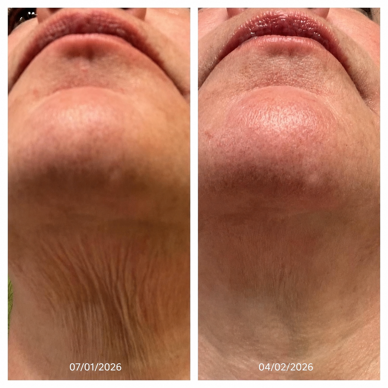 Crema para el cuello Reafirma & Alisa Nuvessia®